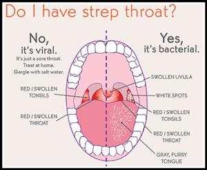 Image result for strep throat